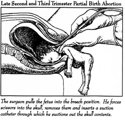 abortion stick